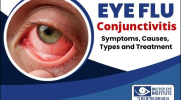 Eye Flu (Conjunctivitis): Causes, Symptoms, Types, and Treatment