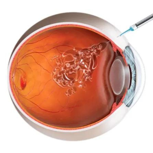 Intravitreal Injection Systems