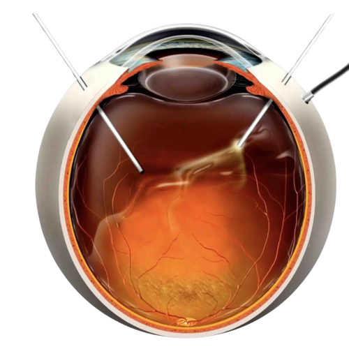 Vitrectomy Machine (2)